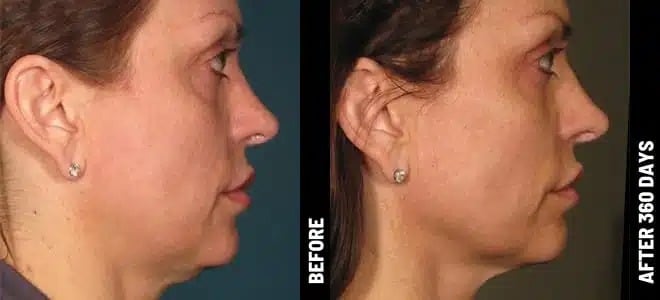 side view of female patient’s face before and after ultherapy skin treatment