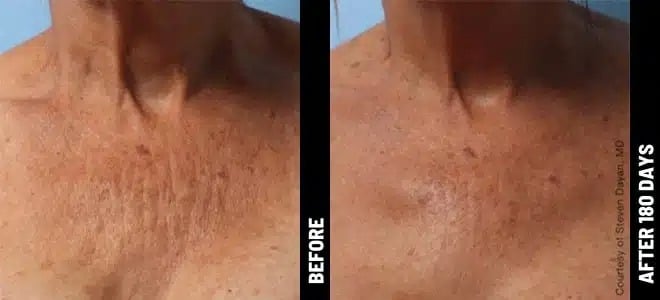 patient’s chest before and after ultherapy, fewer wrinkles after treatment