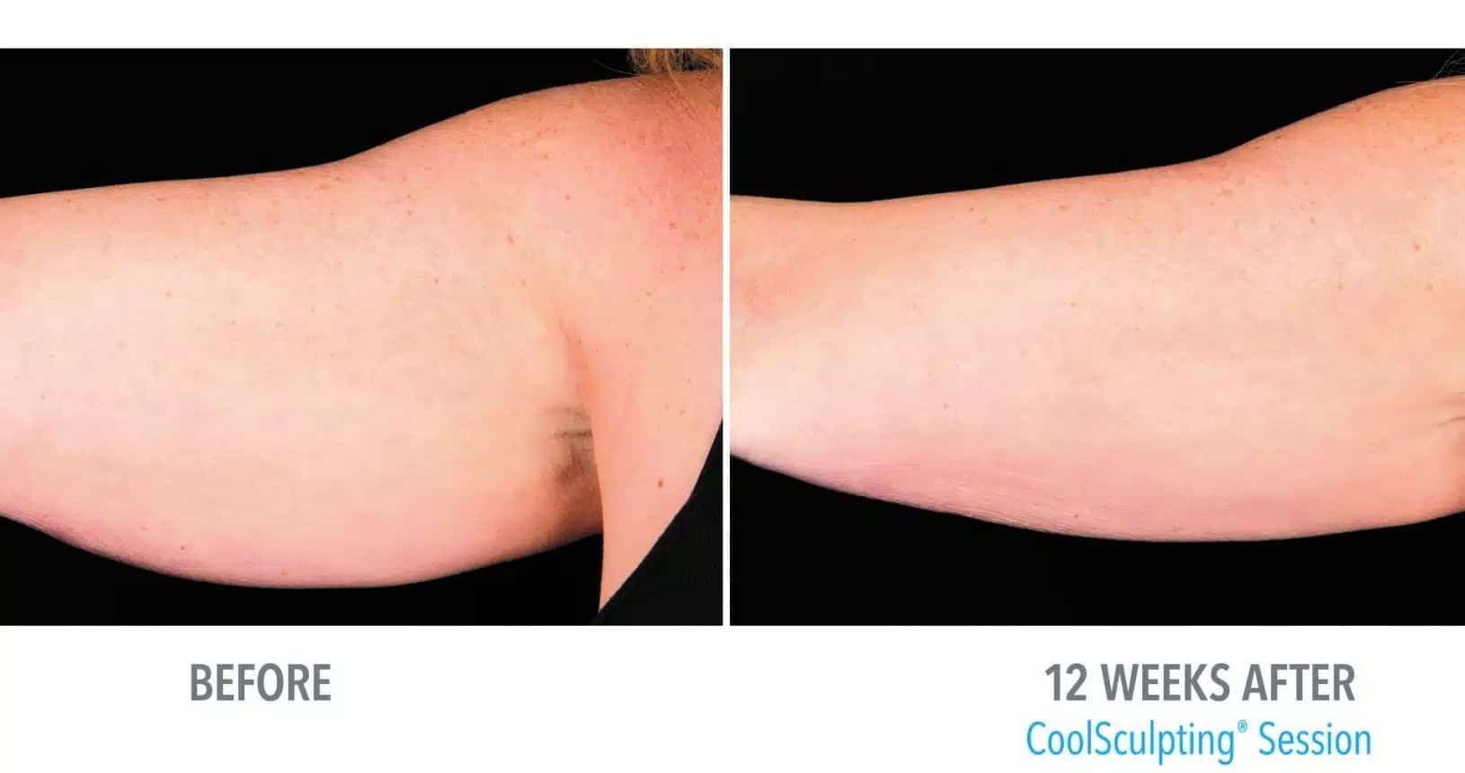 patient’s arm fat or bat wings before and after coolsculpting, less fat after procedure