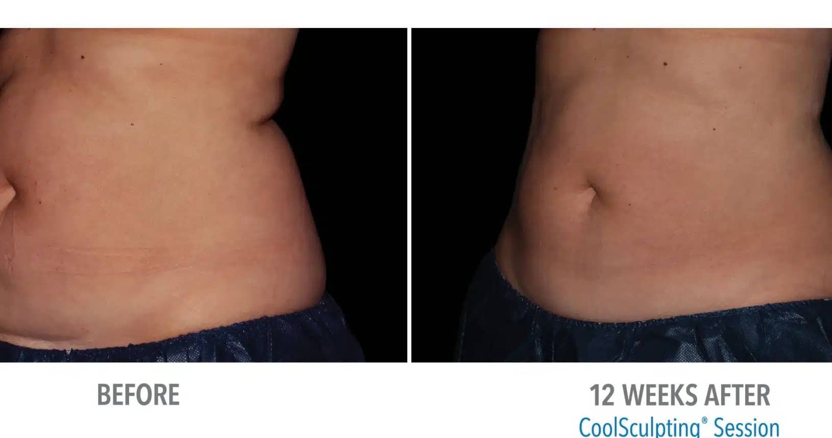 CoolSculpting Before and After B (1)