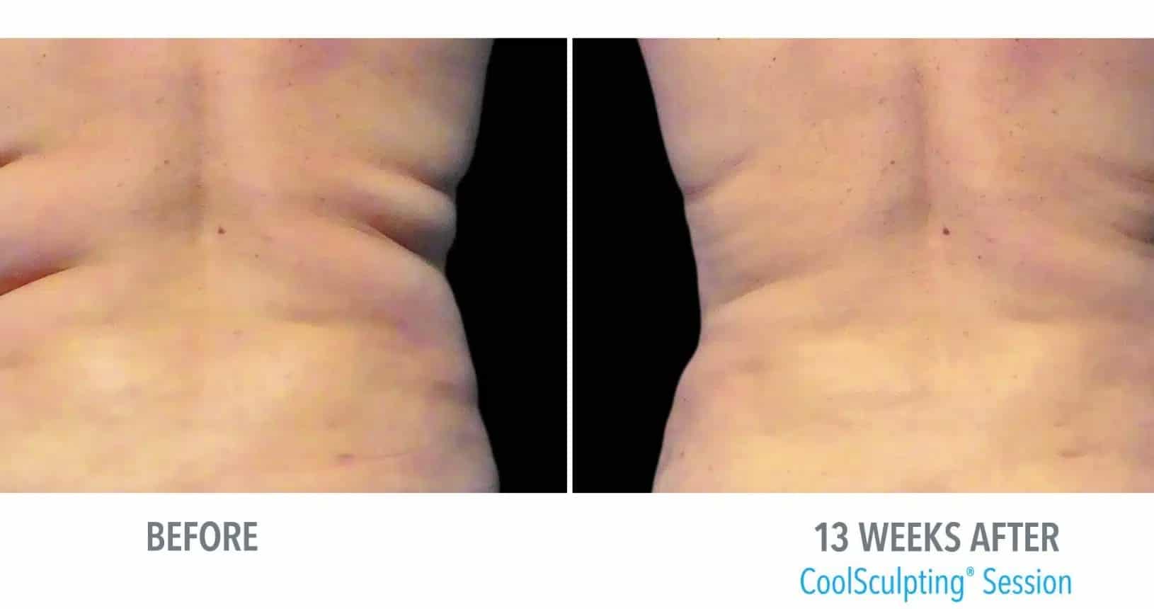 patient's back before and after coolsculpting, less back fat after procedure