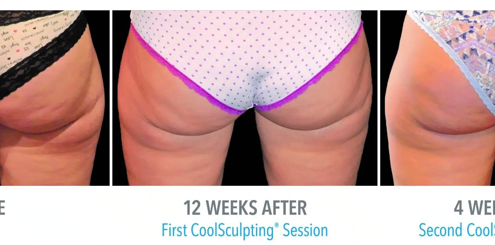 CoolSculpting Before and After B (3)