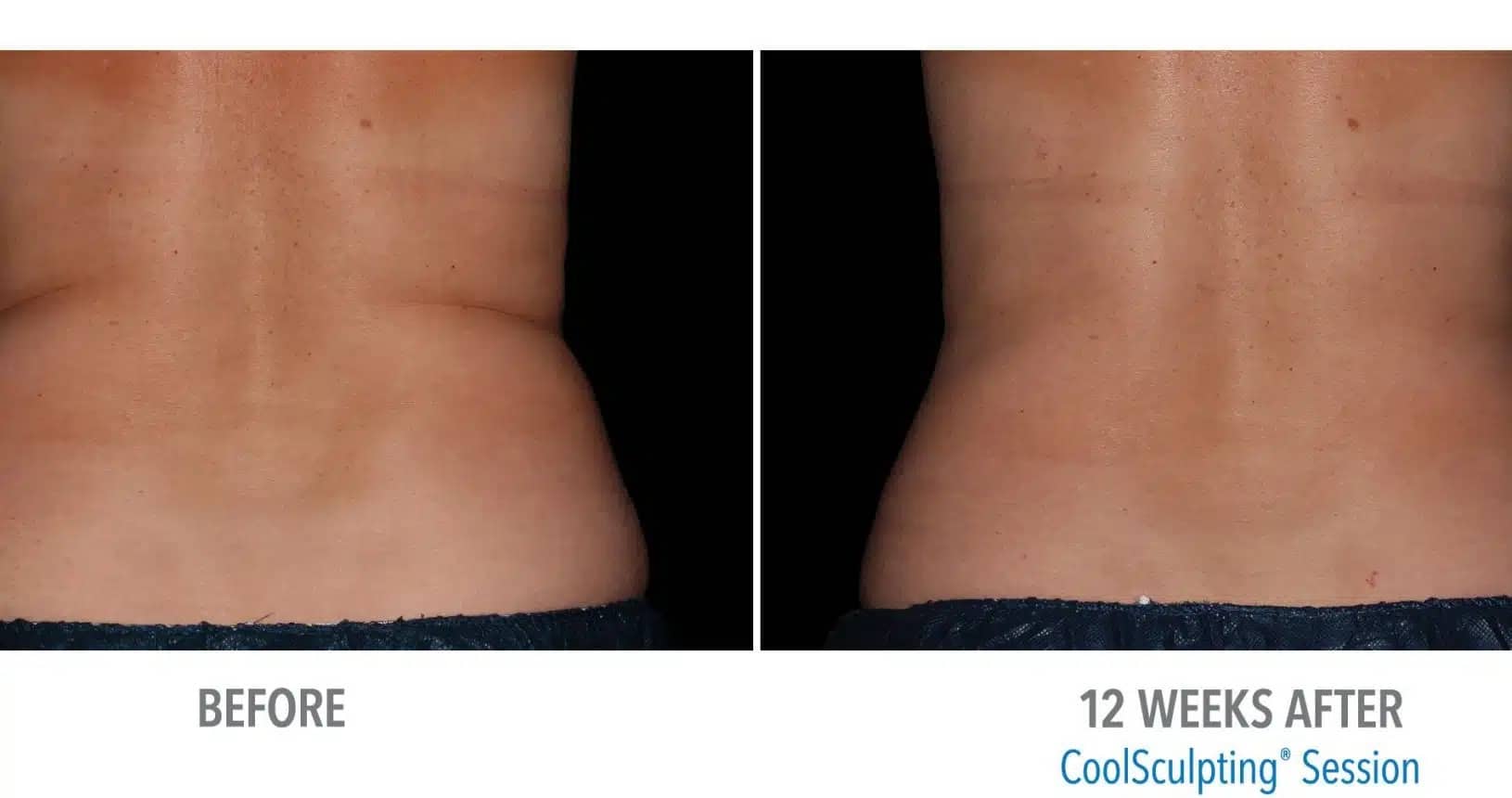 CoolSculpting Before and After B (4)