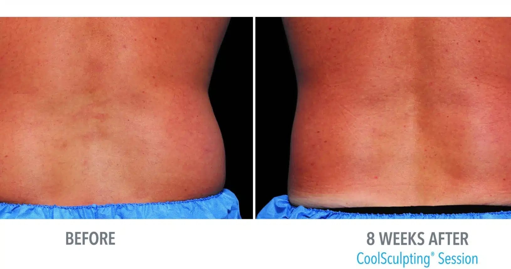 CoolSculpting Before and After B (5)