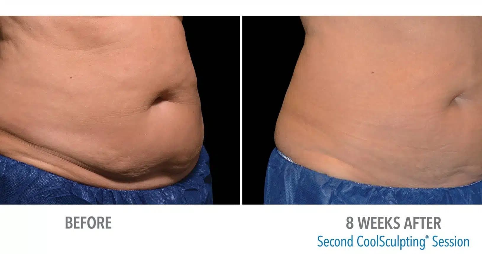 CoolSculpting Before and After B