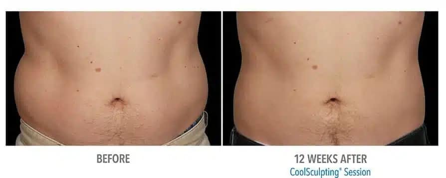 CoolSculpting Before and After S