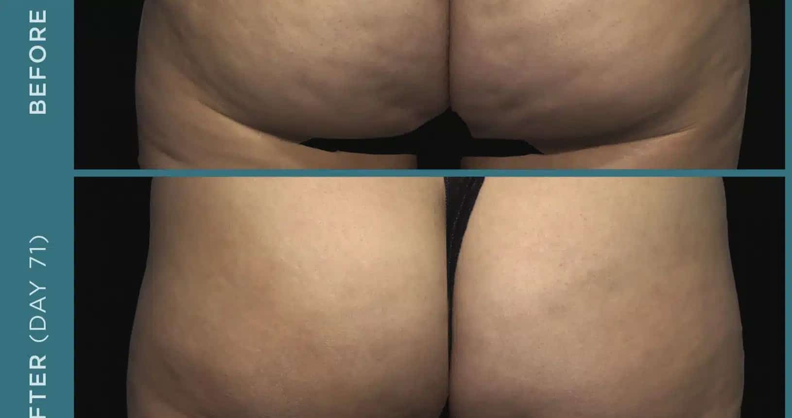 before and after qwo cellulite treatment