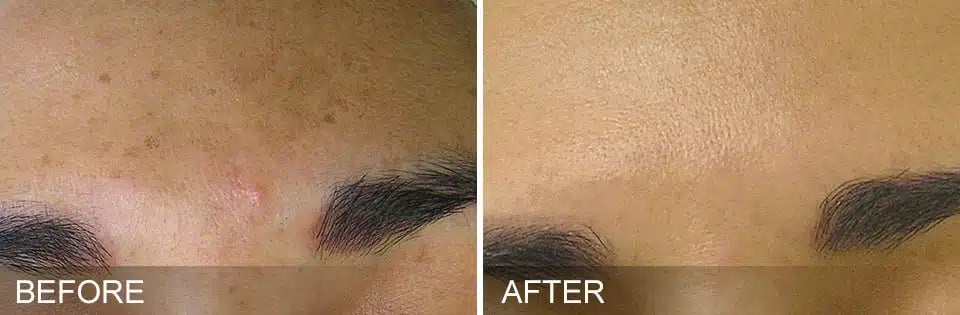 Hydrafacial Before and After 2 2