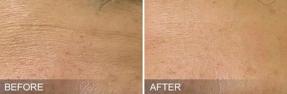 Hydrafacial Before and After 3 2