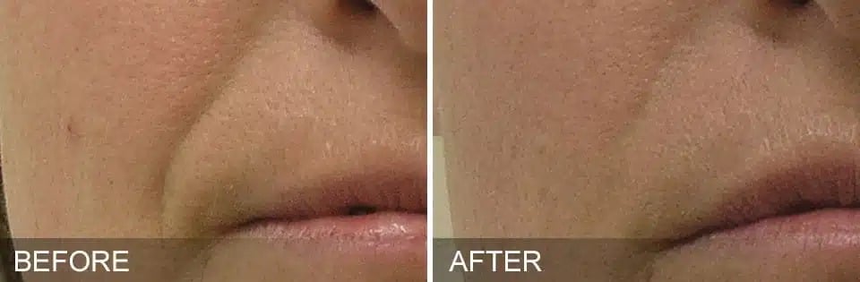 Hydrafacial Before and After 4 2