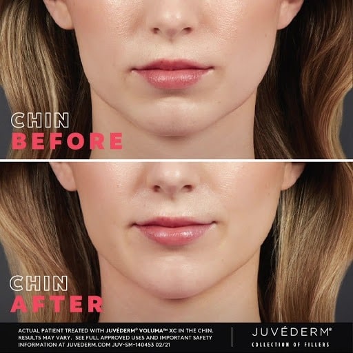 young woman's lips and chin before and after dermal filler treatment
