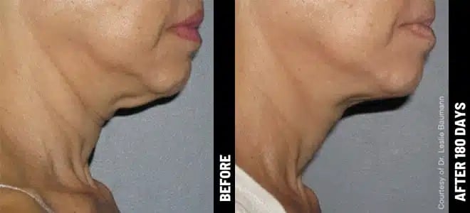 Neck 03@1x ULTHERAPY.jpg