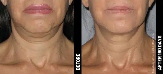 Neck 08@1x ULTHERAPY.jpg