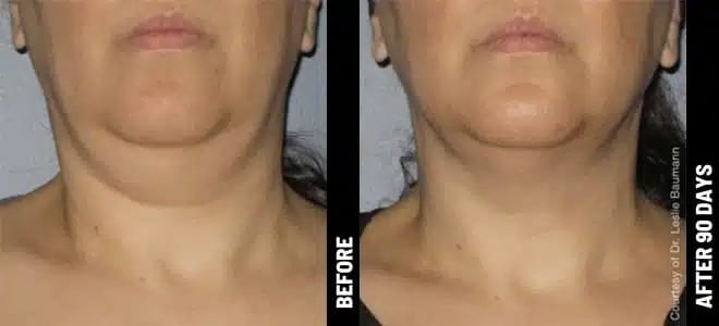 Neck 09@1x ULTHERAPY.jpg