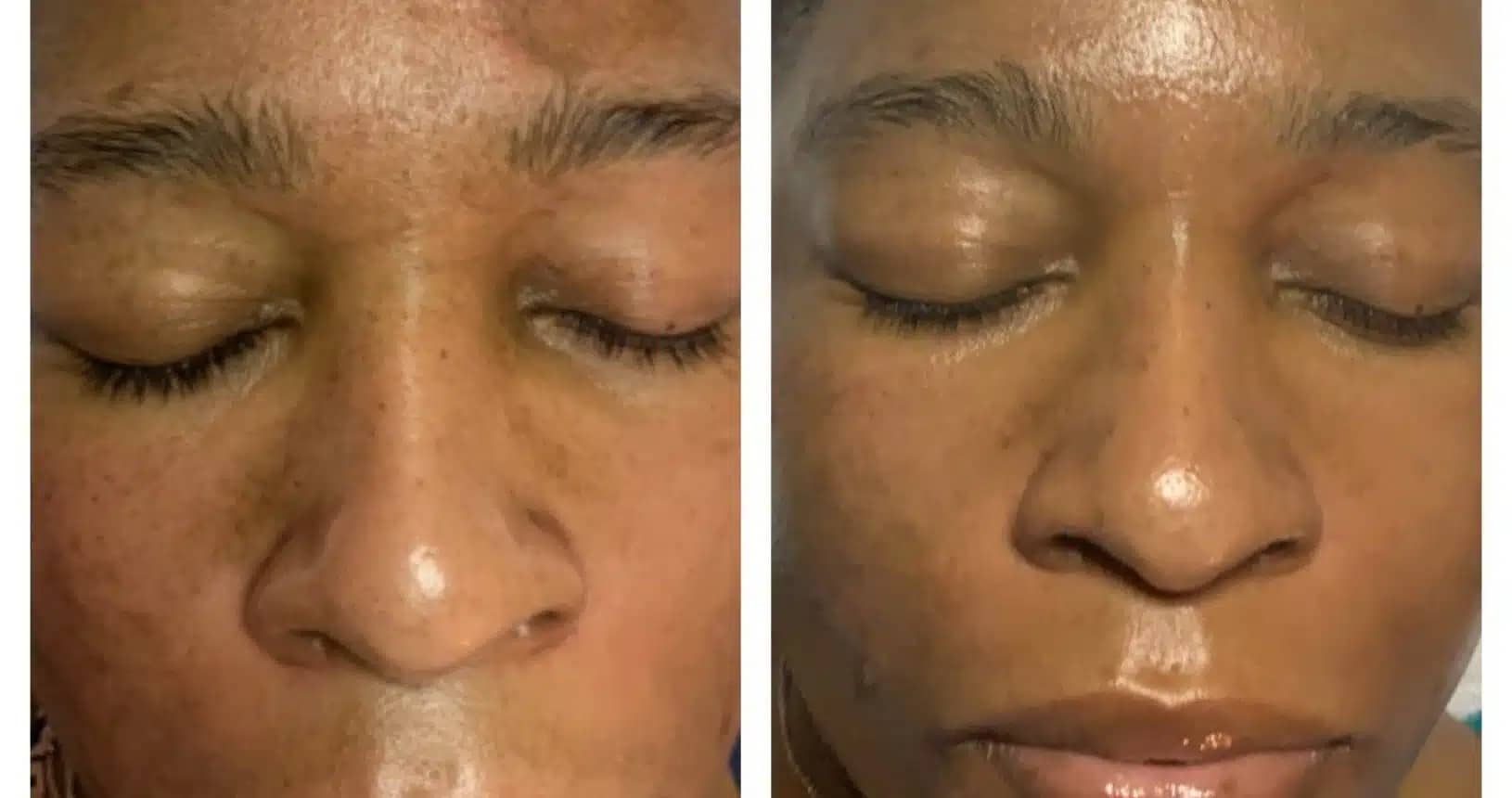 hydrafacial before and After 8 1