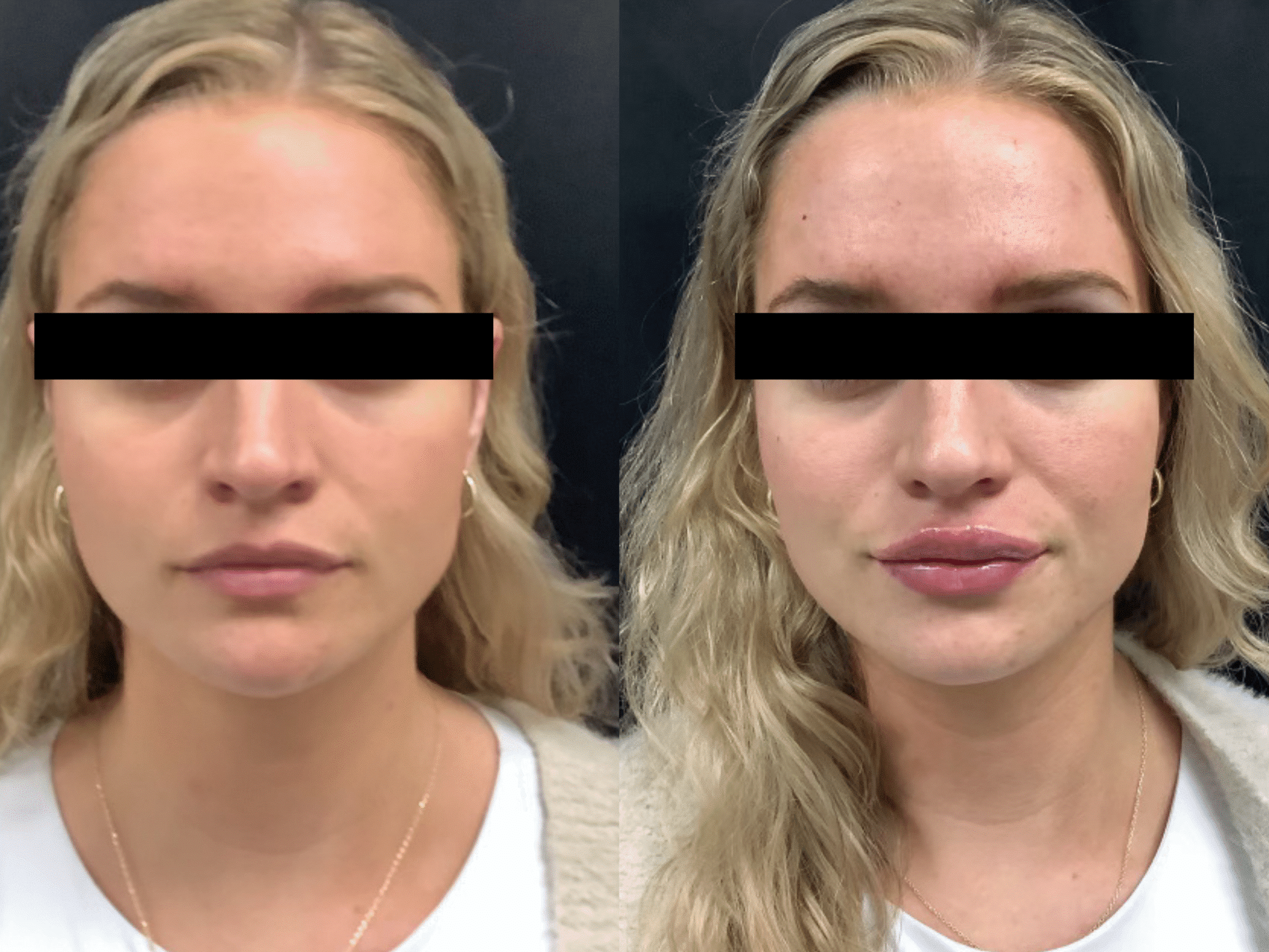 Before & After Dermal Fillers Treatment Atlanta GA Before & After Dermal Fillers Treatment Atlanta GA