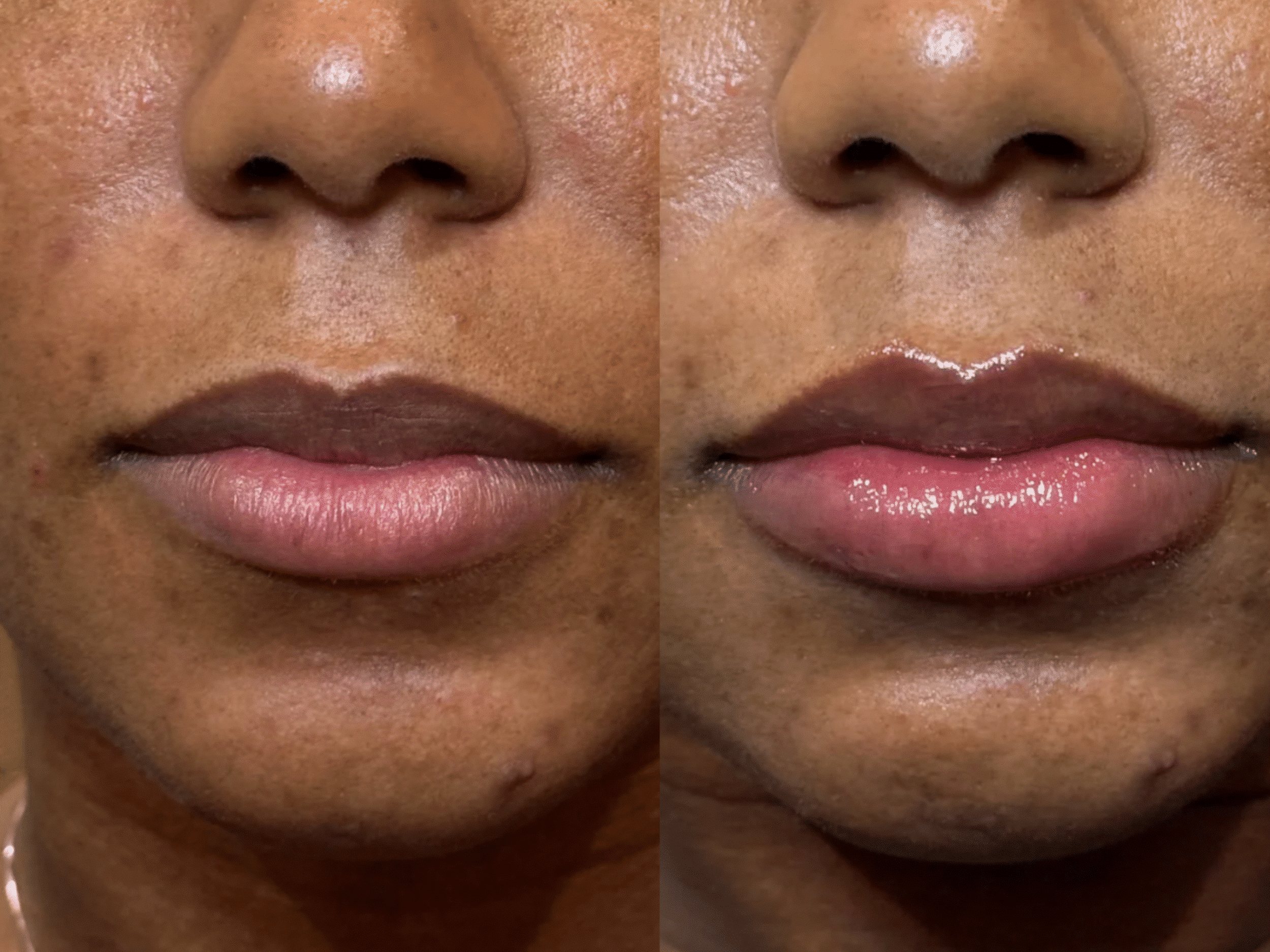 Before & After Dermal Fillers Alpharetta GA Before & After Dermal Fillers Alpharetta GA