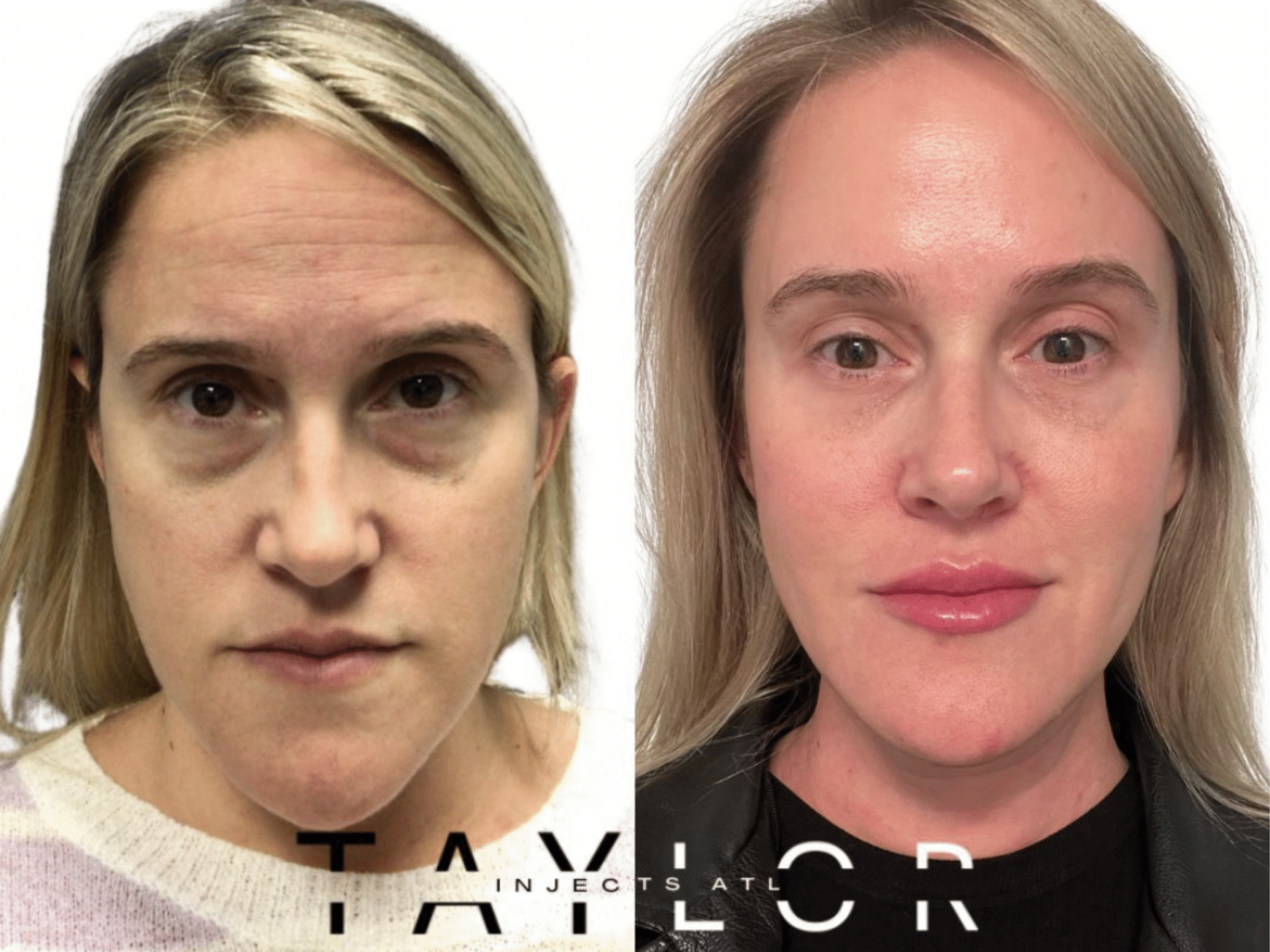 Before & After Dermal Fillers Atlanta GA Before & After Dermal Fillers Atlanta GA