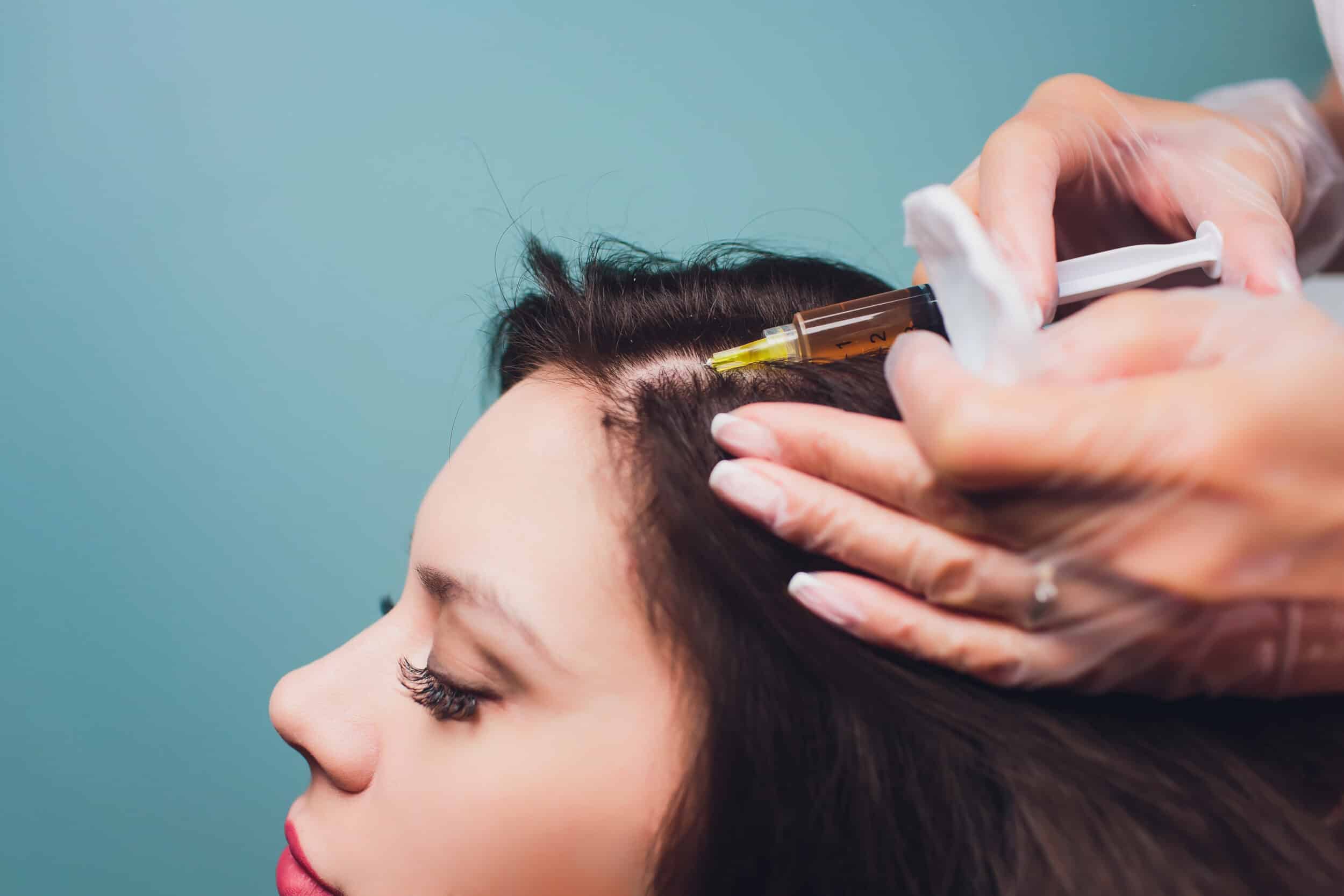 A woman getting PRP injections in her scalp A woman getting PRP injections in her scalp
