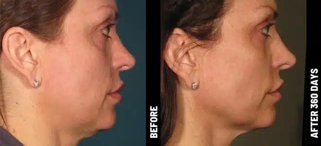 BA_face@1x-ULTHERAPY.jpg (1)
