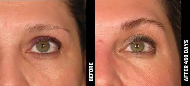 Brow_03@1x-ULTHERAPY.jpg