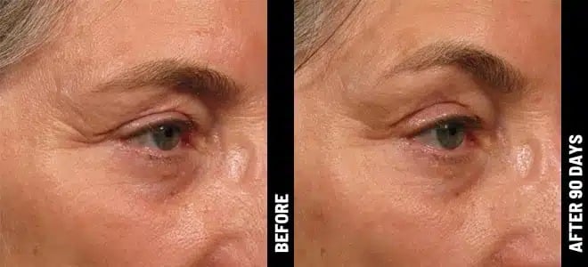 Brow_04@1x-ULTHERAPY.jpg