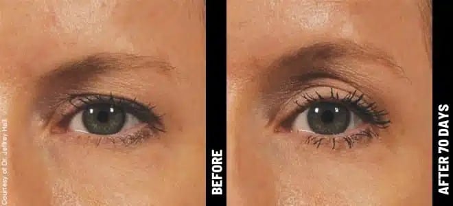 Brow_10@1x-ULTHERAPY.jpg