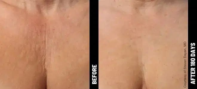 Chest_02@1x-ULTHERAPY.jpg