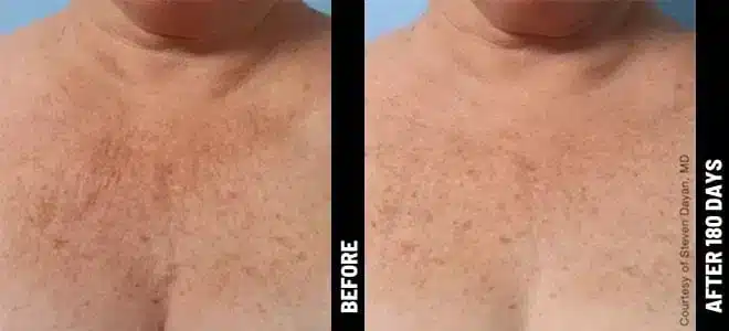 Chest_04@1x-ULTHERAPY.jpg.jpg
