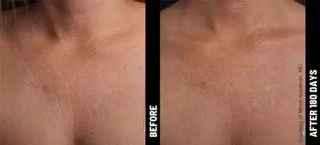 Chest_16@1x-ULTHERAPY.jpg.jpg