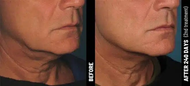 Chin_16@1x-ULTHERAPY.jpg