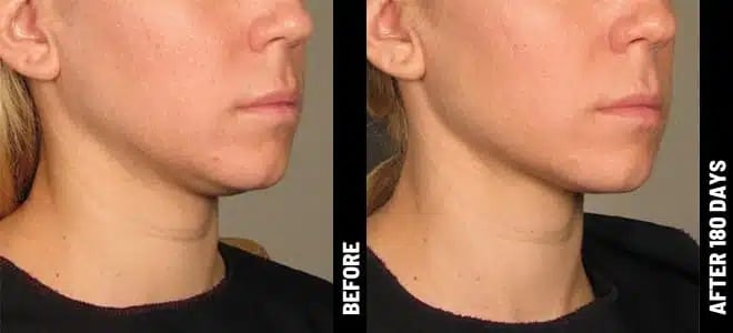 Chin_17@1x-ULTHERAPY.jpg