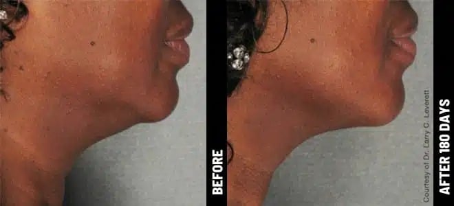 Neck_02@1x-ULTHERAPY.jpg