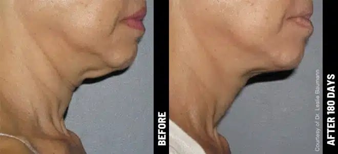 Neck_03@1x-ULTHERAPY.jpg