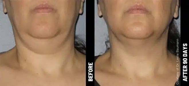 Neck_09@1x-ULTHERAPY.jpg (1)